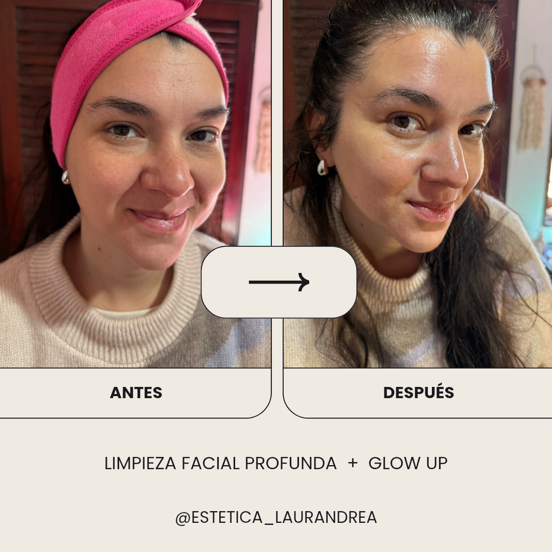 Resultado real de un tratamiento de limpieza facial profunda y glow up